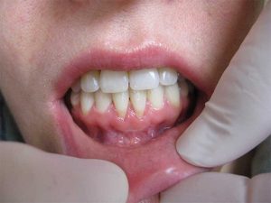 جراحی لثه برای کامپوزیت