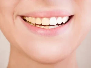 زرد شدن کامپوزیت دندان