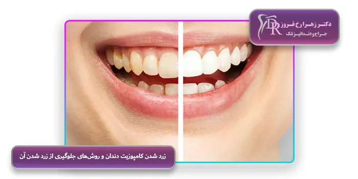 زرد شدن کامپوزیت دندان و روش‌های جلوگیری از زرد شدن آن