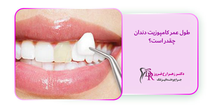 طول عمر کامپوزیت دندان چقدر است؟