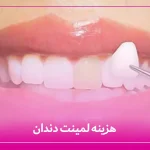 قیمت لمینت دندان
