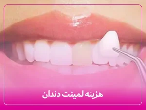 قیمت لمینت دندان