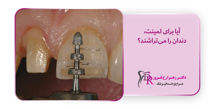 آیا برای لمینت، دندان را می‌تراشند؟