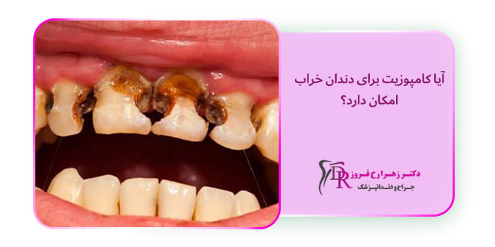 آیا کامپوزیت برای دندان خراب امکان دارد؟