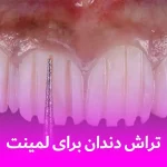 تراش دندان برای لمینت