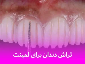 تراش دندان برای لمینت
