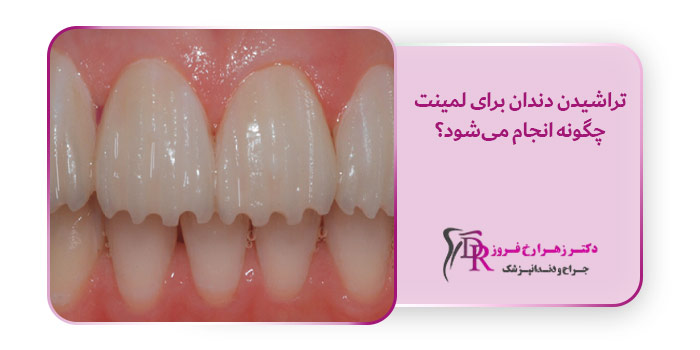 تراشیدن دندان برای لمینت چگونه انجام می‌شود؟