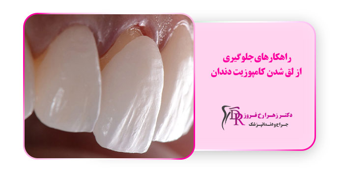 راهکارهای جلوگیری از لق شدن کامپوزیت دندان