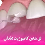 لق شدن کامپوزیت دندان