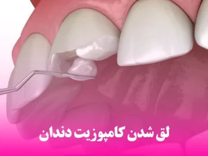 لق شدن کامپوزیت دندان