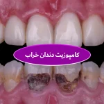 کامپوزیت دندان خراب