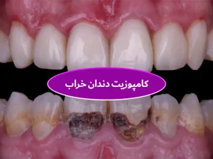 کامپوزیت دندان خراب