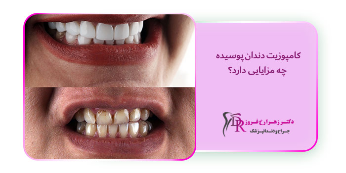 کامپوزیت دندان پوسیده چه مزایایی دارد؟