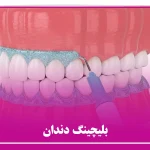 بلیچینگ دندان