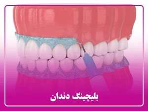 بلیچینگ دندان