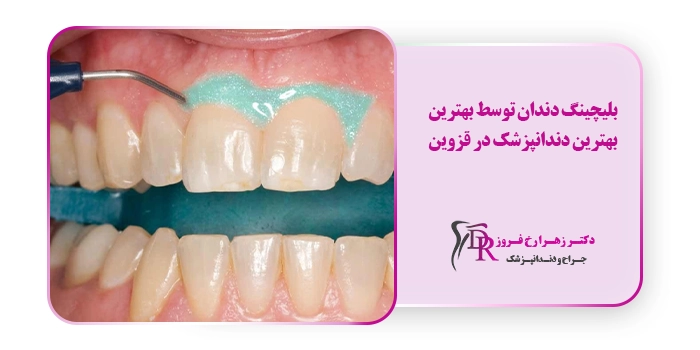 بلیچینگ دندان توسط بهترین بهترین دندانپزشک در قزوین