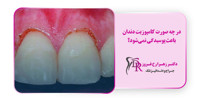 در چه صورت کامپوزیت دندان باعث پوسیدگی نمی‌شود؟