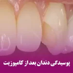 پوسیدگی دندان بعد از کامپوزیت