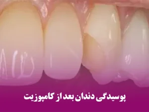 پوسیدگی دندان بعد از کامپوزیت