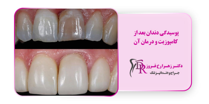 پوسیدگی دندان بعد از کامپوزیت و درمان آن