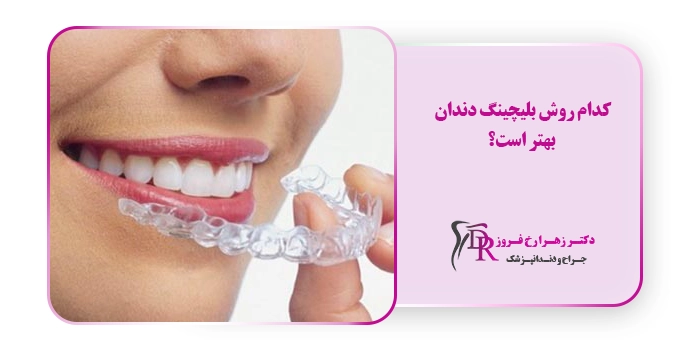 کدام روش بلیچینگ دندان بهتر است؟