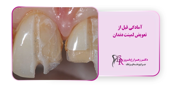 آمادگی قبل از تعویض لمینت دندان