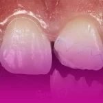 ترمیم لمینت دندان
