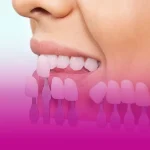تعویض لمینت دندان