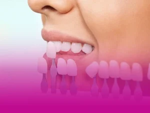 تعویض لمینت دندان