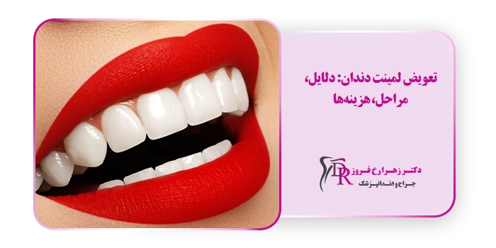تعویض لمینت دندان: دلایل، مراحل، هزینه‌ها