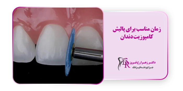 زمان مناسب برای پالیش کامپوزیت دندان
