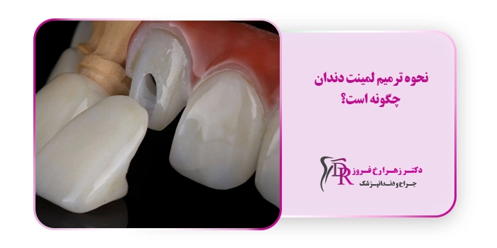 نحوه ترمیم لمینت دندان چگونه است؟