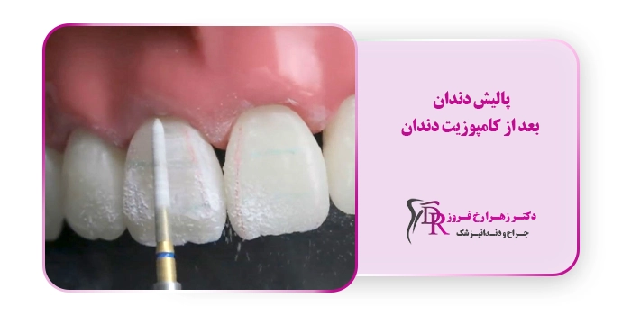 پالیش دندان بعد از کامپوزیت دندان