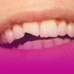 لمینت دندان شکسته لمینت دندان شکسته یکی از راهکارهای بهتر کردن ظاهر دندان‌های شکسته است. دندان بسیاری از افراد به دلایلی مورد آسیب واقع می‌شوند و این آسیب می‌تواند شکستگی دندان باشد. اگر دندان‌های جلویی شکسته شوند، هنگام صحبت کردن یا خندیدن ظاهر نامطلوبی دارد. لمینت یکی از ساده‌ترین راه‌هایی است که می‌توان این شکستگی را برطرف کرد. لمینت روکش نازک از جنس سرامیک است که برای پوشش عیوب دندان‌های جلو روی مینا دندان چسبانیده می‌شود. با استفاده از لمینت، رنگ، شکل و اندازه دندان تغییر می‌کند. در ادامه به مزایای لمینت دندان شکسته و نحوه انجام آن می‌پردازیم. ایا می توان از لمینت برای دندان شکسته استفاده کرد؟ قبل از انجام لمینت، دندانپزشک به‌ طور دقیق تمامی دندان‌های شما را بررسی می‌کند. گاهی ممکن است ترک‌های ریزی در دندان وجود داشته باشد که با چشم دیده نشوند، اما همین ترک‌های کوچک می‌توانند باعث پوسیدگی و آسیب‌های جدی شوند. به همین دلیل، معاینه دقیق قبل از لمینت کردن دندان‌ها ضروری است. از سوی دیگر، اگر شکستگی دندان کاملا مشخص باشد، مانند زمانی که دندان جلویی در اثر ضربه حین ورزش ترک خورده یا بخشی از آن شکسته است، می‌توان در برخی موارد از لمینت برای ترمیم استفاده کرد. البته این روش فقط در صورتی کاربرد دارد که ساختار اصلی دندان به اندازه کافی محکم باشد و بتواند لمینت را نگه دارد. لمینت دندان شکسته به‌خ صوص برای دندان‌های جلو، یکی از روش‌های پرطرفدار در دندانپزشکی زیبایی است. اما نباید فراموش کرد که در صورت شکستگی شدید، لمینت گزینه مناسبی نخواهد بود و روش‌های دیگری مانند روکش دندانی یا درمان‌های تخصصی‌تر پیشنهاد می‌شود. کاربرد لمینت دندان شکسته لمینت دندان نه‌ تنها روشی مناسب برای ترمیم دندان‌های شکسته است، بلکه کاربردهای گسترده‌ای در دندانپزشکی زیبایی دارد. این روش به شما کمک می‌کند تا لبخندی زیبا، دندان‌هایی یکدست و عملکردی مطلوب داشته باشید. لمینت‌ها با ظاهری طبیعی، نقص‌های دندانی را پوشش داده و به بهبود اعتماد به ‌نفس شما کمک می‌کنند. علاوه بر اصلاح شکستگی‌های دندانی، لمینت در موارد زیر نیز مورد استفاده قرار می‌گیرد: • بستن فاصله‌های بین دندان‌های جلو • سفید کردن دندان‌هایی که به دلایل مختلف بیش از حد تیره شده‌اند و به روش‌های معمول سفید کننده‌ها پاسخ نمی‌دهند • ترمیم دندان‌هایی که به دلیل پوسیدگی یا به‌ هم ‌ریختگی شدید نیاز به اصلاح کلی دارند با توجه به این کاربردها، لمینت گزینه‌ای عالی برای افرادی است که به دنبال بهبود زیبایی و سلامت دندان‌های خود هستند. مراحل انجام لمینت دندان شکسته در ابتدا رفع تمامی پوسیدگی‌های دندانی قبل از انجام لمینت ضروری است؛ زیرا لمینت مانند یک لایه نازک روی دندان قرار می‌گیرد و اگر دندان زیر آن دچار خرابی باشد، مشکلات بیشتری ایجاد خواهد شد. پوسیدگی ممکن است به قسمت‌های عمیق‌تر نفوذ کرده و درمان را پیچیده‌تر کند. علاوه بر این، در صورت نیاز به ترمیم پوسیدگی پس از لمینت، احتمال آسیب به لمینت و نیاز به تعویض لمینت وجود دارد. بعد از رفع هرگونه پوسیدگی و مشکلات دندانی، می‌توان دندان‌های شکسته را لمینت کرد. روند لمینت دندان شکسته مشابه لمینت سایر دندان‌ها است. در ابتدا، دندانپزشک معاینه کاملی انجام می‌دهد تا میزان شکستگی مشخص شود. اگر امکان لمینت کردن دندان وجود داشته باشد، رنگ مناسب لمینت انتخاب می‌شود. سپس، در صورت وجود پوسیدگی، درمان‌های لازم انجام می‌گیرد. بعد از آن، بخشی از مینای دندان تراشیده می‌شود تا سطح دندان یکدست شده و آماده چسباندن لمینت گردد. این کار همچنین از ضخیم شدن بیش‌ازحد دندان پس از لمینت جلوگیری کرده و باعث حفظ ظاهر طبیعی دندان‌ها می‌شود. در مرحله بعد، قالب‌گیری انجام می‌شود. دندانپزشک با استفاده از مواد مخصوص، قالب دندان را تهیه می‌کند تا لمینت متناسب با فرم دندان‌ها ساخته شود. آماده شدن لمینت حدود دو هفته طول می‌کشد. در این مدت، روکش موقتی روی دندان قرار می‌گیرد تا از آسیب احتمالی جلوگیری شود. پس از آماده شدن لمینت، دندانپزشک آن را روی دندان نصب کرده و تنظیمات نهایی را انجام می‌دهد. در صورتی که مشکلی در قرارگیری لمینت وجود داشته باشد، با اصلاحات جزئی، سطح دندان به شکلی متناسب و طبیعی در می‌آید. مزایای لمینت دندانی که شکسته لمینت مزایای مختلفی دارد که در ظاهر و عملکرد دندان تاثیر زیادی می‌گذارند این مزایا عبارتند از: رنگ و ظاهر طبیعی: یکی از مهم‌ترین دلایل محبوبیت لمینت، حفظ ظاهر طبیعی آن است. با انتخاب رنگ مناسب، لمینت دندان شما به گونه‌ای خواهد بود که نه تنها دندان‌های شما بیش از حد سفید نمی‌شود، بلکه رنگ آن به طور طبیعی با سایر دندان‌ها هماهنگ خواهد بود. جلوگیری از آسیب به ریشه دندان و لثه: درمان شکستگی یا ترک دندان می‌تواند از گسترش پوسیدگی، شکستن بیشتر دندان و آسیب رسیدن به ریشه و لثه‌ها جلوگیری کند، بنابراین با لمینت، مشکلات بزرگتر به طور مؤثری پیشگیری می‌شود. رفع مشکلات گفتاری: شکسته شدن دندان‌های جلو می‌تواند تأثیر زیادی روی تلفظ کلمات و حروف بگذارد. انجام لمینت روی دندان شکسته باعث بهبود توانایی در بیان صحیح کلمات و جمله‌ها می‌شود. بهبود توانایی جویدن غذا: وقتی بخشی از دندان شکسته باشد، خوردن غذا به ویژه غذاهای سفت ممکن است دشوار شود. با انجام لمینت، آسیب‌های جزئی ترمیم شده و عملکرد دندان بهبود می‌یابد، که باعث می‌شود فرد بتواند به راحتی غذا بخورد. رفع لبه‌های تیز دندان: پس از شکستگی دندان، لبه‌های آن به شدت تیز می‌شود که ممکن است باعث آسیب به زبان و لثه شود. با استفاده از لمینت دندان شکسته، این لبه‌های تیز پر شده و سطح دندان یکدست و ایمن می‌شود، به طوری که از زخم شدن لثه‌ها یا زبان جلوگیری می‌شود. در چه صورت لمینت برای دندان شکسته مناسب است؟ لمینت برای دندان‌های شکسته زمانی مناسب است که آسیب وارد شده به دندان کم و محدود باشد. اگر دندان دچار شکستگی شدید شده باشد و توانایی نگه‌داری لمینت را نداشته باشد، این روش ترمیمی ممکن است گزینه مناسبی نباشد. در این شرایط، باید از روش‌های درمانی جایگزین برای ترمیم دندان استفاده کرد. در صورتی که دندان قدرت لازم برای نگهداری لمینت را داشته باشد، می‌توان از این روش بهره برد. اما اگر آسیب به دندان به حدی شدید باشد که امکان استفاده از لمینت وجود نداشته باشد، گزینه‌هایی مانند تاج دندان یا ایمپلنت می‌توانند راه‌حل‌های مناسب‌تری باشند. تشخیص نهایی در مورد مناسب‌ترین روش ترمیمی باید توسط دندان پزشک انجام شود. طول عمر لمینت دندان شکسته چقدر است؟ طول عمر لمینت‌های دندانی بین ۱۰ تا ۱۵ سال برآورد می‌شود. با این حال، این مدت زمان می‌تواند بسته به عواملی مانند کیفیت مواد استفاده شده، میزان مراقبت بیمار و دقت در نصب روکش متفاوت باشد. یکی از مهم‌ترین عواملی که می‌تواند به طولانی‌تر شدن عمر لمینت‌ها کمک کند، رعایت بهداشت دهان و دندان و مراقبت‌های بعد از لمینت است. روش های دیگر برای اصلاح و ترمیم دندان شکسته علاوه بر لمینت دندان شکسته، روش‌های درمانی دیگری نیز برای ترمیم دندان آسیب ‌دیده وجود دارد. دندانپزشک بعد از معاینه و بررسی وضعیت دندان شما، مناسب‌ترین روش درمانی را پیشنهاد خواهد کرد. در ادامه به برخی از این روش‌ها اشاره شده است: پرکردن یا باندینگ دندان‌های شکسته اگر تنها قسمت کوچکی از مینای دندان آسیب دیده باشد، دندانپزشک می‌تواند از روش پرکردن برای ترمیم آن استفاده کند. در صورتی که این آسیب در دندان‌های جلویی باشد یا هنگام لبخند زدن دیده شود، از تکنیک باندینگ استفاده می‌شود. در این روش از رزین کامپوزیت همرنگ دندان برای ترمیم استفاده می‌شود. باندینگ مشابه لمینت است و نیازی به بی‌حسی ندارد. در ابتدا سطح دندان با مایع خاصی تمیز و زبر می‌شود تا باندینگ به خوبی چسبیده و سپس رزین همرنگ دندان روی آن اعمال می‌شود. پس از شکل دادن مواد به فرم طبیعی دندان، دندانپزشک با استفاده از نور ماوراء بنفش مواد را سفت می‌کند. پروتز تاج دندان اگر بخش بزرگی از دندان شکسته باشد یا دندان به شدت پوسیده شده باشد، دندان‌پزشک می‌تواند بخشی از دندان باقی‌ مانده را تراشیده و آن را با روکش تاج پوشش دهد. این تاج‌ها می‌توانند از مواد مختلفی مانند فلز-سرامیک، زیرکونیا یا تمام سرامیک ساخته شوند. هر یک از این مواد مزایای خاص خود را دارند. تاج‌های فلزی سرامیکی به دلیل استحکام و دوام بالا شناخته شده‌اند. تاج‌های تمام سرامیکی ظاهری شبیه به دندان طبیعی دارند، و تاج‌های زیرکونیا ترکیبی از زیبایی و عملکرد را ارائه می‌دهند. در صورتی که نوک دندان به طور کامل شکسته باشد اما ریشه سالم باقی بماند (دندان نیمه‌شکسته)، ممکن است درمان ریشه برای پاکسازی کانال ریشه انجام شود تا پایه‌ای سالم برای نصب تاج فراهم شود. برای نصب پروتز تاج، دو جلسه دندانپزشکی لازم است. در جلسه اول، دندان‌پزشک ممکن است تصویربرداری برای بررسی ریشه دندان و استخوان اطراف آن انجام دهد. اگر مشکلی نباشد، دندانپزشک دندان و لثه را بی‌حس کرده و دندان باقی ‌مانده را به اندازه‌ای سوهان می‌زند که فضایی برای نصب تاج ایجاد شود. هزینه لمینت دندان شکسته چقدر است؟ هزینه ترمیم دندان شکسته با لمینت به عوامل مختلفی مانند تعداد دندان‌های نیازمند درمان، میزان آسیب دندان و نیاز به مراحل اضافی مانند رفع پوسیدگی بستگی دارد. بنابراین، تعیین یک قیمت دقیق و کلی برای این خدمات امکان‌پذیر نیست. برای آگاهی از هزینه دقیق، بهتر است به دندانپزشک مراجعه کرده تا دندان‌های شما به طور کامل معاینه شوند و پس از آن قیمت مناسب برای انجام این درمان به شما اعلام گردد. مراقبت‌های بعد از لمینت دندان شکسته برای حفظ سلامت روکش‌های لمینت خود باید همان‌ طور که از دندان‌های طبیعی‌تان مراقبت می‌کنید، دقت بیشتری به این روکش‌ها داشته باشید. زیرا دندان‌های لمینت شده ممکن است در برابر آسیب بیشتر حساس باشند و نیاز به نگهداری دقیق‌تری دارند. برای مراقبت از دندان‌های لمینت شده، توصیه می‌شود که روزانه دو بار مسواک بزنید و حداقل یک بار از نخ دندان استفاده کنید. همچنین، برای جلوگیری از آسیب به روکش‌ها، از خمیر دندان‌های مخصوص لمینت استفاده کنید. علاوه بر این، از جویدن مواد سخت یا وارد کردن فشار زیاد به دندان‌های خود پرهیز کنید تا از خطر کنده شدن روکش‌ها جلوگیری کنید. سخن پایانی در نهایت، لمینت دندان شکسته یک راه‌ حل موثر و زیباسازی است که می‌تواند ظاهر دندان‌های شما را به طور قابل توجهی بهبود بخشد. این روش نه تنها به ترمیم دندان‌های آسیب‌ دیده کمک می‌کند، بلکه عملکرد دندان‌ها را نیز به حالت طبیعی باز می‌گرداند. اما به یاد داشته باشید که انتخاب لمینت باید تحت نظر دندان‌پزشک متخصص و پس از ارزیابی دقیق وضعیت دندان‌ها انجام شود. با مراقبت‌های مناسب و رعایت نکات بهداشتی، می‌توانید از طول عمر بیشتر لمینت‌های خود بهره‌مند شوید و لبخندی زیبا و طبیعی داشته باشید. سوالات متداول آیا انجام لمینت دندان برای دندان‌های شکسته به سلامت دندان آسیب می‌زند؟ در صورتی که مراحل لمینت‌گذاری به درستی انجام شود، هیچ آسیبی به سلامت دندان وارد نمی‌شود. دندانپزشک قبل از نصب لمینت، دندان‌ها را بررسی کرده و از هرگونه آسیب احتمالی جلوگیری می‌کند. اگر دندان‌ها به شدت آسیب ‌دیده باشند، ابتدا باید ترمیم شوند. آیا پس از نصب لمینت دندان شکسته می‌توان غذاهای گرم و سرد مصرف کرد؟ پس از نصب لمینت، هیچ محدودیتی برای مصرف غذاهای گرم یا سرد وجود ندارد. اما باید مراقب باشید که از خوردن غذاهای خیلی سخت یا چسبناک که ممکن است به لمینت آسیب بزنند، پرهیز کنید. آیا نصب لمینت برای دندان شکسته نیاز به بی‌حسی دارد؟ در بیشتر موارد نصب لمینت دندان شکسته بدون نیاز به بی‌حسی انجام می‌شود، به جز در صورتی که دندان‌پزشک نیاز به انجام تغییرات یا تراش دادن بخش‌های اضافی از دندان داشته باشد. در این صورت ممکن است بی‌حسی برای راحتی بیشتر بیمار استفاده شود.