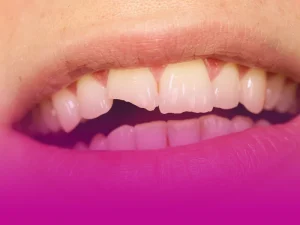 لمینت دندان شکسته لمینت دندان شکسته یکی از راهکارهای بهتر کردن ظاهر دندان‌های شکسته است. دندان بسیاری از افراد به دلایلی مورد آسیب واقع می‌شوند و این آسیب می‌تواند شکستگی دندان باشد. اگر دندان‌های جلویی شکسته شوند، هنگام صحبت کردن یا خندیدن ظاهر نامطلوبی دارد. لمینت یکی از ساده‌ترین راه‌هایی است که می‌توان این شکستگی را برطرف کرد. لمینت روکش نازک از جنس سرامیک است که برای پوشش عیوب دندان‌های جلو روی مینا دندان چسبانیده می‌شود. با استفاده از لمینت، رنگ، شکل و اندازه دندان تغییر می‌کند. در ادامه به مزایای لمینت دندان شکسته و نحوه انجام آن می‌پردازیم. ایا می توان از لمینت برای دندان شکسته استفاده کرد؟ قبل از انجام لمینت، دندانپزشک به‌ طور دقیق تمامی دندان‌های شما را بررسی می‌کند. گاهی ممکن است ترک‌های ریزی در دندان وجود داشته باشد که با چشم دیده نشوند، اما همین ترک‌های کوچک می‌توانند باعث پوسیدگی و آسیب‌های جدی شوند. به همین دلیل، معاینه دقیق قبل از لمینت کردن دندان‌ها ضروری است. از سوی دیگر، اگر شکستگی دندان کاملا مشخص باشد، مانند زمانی که دندان جلویی در اثر ضربه حین ورزش ترک خورده یا بخشی از آن شکسته است، می‌توان در برخی موارد از لمینت برای ترمیم استفاده کرد. البته این روش فقط در صورتی کاربرد دارد که ساختار اصلی دندان به اندازه کافی محکم باشد و بتواند لمینت را نگه دارد. لمینت دندان شکسته به‌خ صوص برای دندان‌های جلو، یکی از روش‌های پرطرفدار در دندانپزشکی زیبایی است. اما نباید فراموش کرد که در صورت شکستگی شدید، لمینت گزینه مناسبی نخواهد بود و روش‌های دیگری مانند روکش دندانی یا درمان‌های تخصصی‌تر پیشنهاد می‌شود. کاربرد لمینت دندان شکسته لمینت دندان نه‌ تنها روشی مناسب برای ترمیم دندان‌های شکسته است، بلکه کاربردهای گسترده‌ای در دندانپزشکی زیبایی دارد. این روش به شما کمک می‌کند تا لبخندی زیبا، دندان‌هایی یکدست و عملکردی مطلوب داشته باشید. لمینت‌ها با ظاهری طبیعی، نقص‌های دندانی را پوشش داده و به بهبود اعتماد به ‌نفس شما کمک می‌کنند. علاوه بر اصلاح شکستگی‌های دندانی، لمینت در موارد زیر نیز مورد استفاده قرار می‌گیرد: • بستن فاصله‌های بین دندان‌های جلو • سفید کردن دندان‌هایی که به دلایل مختلف بیش از حد تیره شده‌اند و به روش‌های معمول سفید کننده‌ها پاسخ نمی‌دهند • ترمیم دندان‌هایی که به دلیل پوسیدگی یا به‌ هم ‌ریختگی شدید نیاز به اصلاح کلی دارند با توجه به این کاربردها، لمینت گزینه‌ای عالی برای افرادی است که به دنبال بهبود زیبایی و سلامت دندان‌های خود هستند. مراحل انجام لمینت دندان شکسته در ابتدا رفع تمامی پوسیدگی‌های دندانی قبل از انجام لمینت ضروری است؛ زیرا لمینت مانند یک لایه نازک روی دندان قرار می‌گیرد و اگر دندان زیر آن دچار خرابی باشد، مشکلات بیشتری ایجاد خواهد شد. پوسیدگی ممکن است به قسمت‌های عمیق‌تر نفوذ کرده و درمان را پیچیده‌تر کند. علاوه بر این، در صورت نیاز به ترمیم پوسیدگی پس از لمینت، احتمال آسیب به لمینت و نیاز به تعویض لمینت وجود دارد. بعد از رفع هرگونه پوسیدگی و مشکلات دندانی، می‌توان دندان‌های شکسته را لمینت کرد. روند لمینت دندان شکسته مشابه لمینت سایر دندان‌ها است. در ابتدا، دندانپزشک معاینه کاملی انجام می‌دهد تا میزان شکستگی مشخص شود. اگر امکان لمینت کردن دندان وجود داشته باشد، رنگ مناسب لمینت انتخاب می‌شود. سپس، در صورت وجود پوسیدگی، درمان‌های لازم انجام می‌گیرد. بعد از آن، بخشی از مینای دندان تراشیده می‌شود تا سطح دندان یکدست شده و آماده چسباندن لمینت گردد. این کار همچنین از ضخیم شدن بیش‌ازحد دندان پس از لمینت جلوگیری کرده و باعث حفظ ظاهر طبیعی دندان‌ها می‌شود. در مرحله بعد، قالب‌گیری انجام می‌شود. دندانپزشک با استفاده از مواد مخصوص، قالب دندان را تهیه می‌کند تا لمینت متناسب با فرم دندان‌ها ساخته شود. آماده شدن لمینت حدود دو هفته طول می‌کشد. در این مدت، روکش موقتی روی دندان قرار می‌گیرد تا از آسیب احتمالی جلوگیری شود. پس از آماده شدن لمینت، دندانپزشک آن را روی دندان نصب کرده و تنظیمات نهایی را انجام می‌دهد. در صورتی که مشکلی در قرارگیری لمینت وجود داشته باشد، با اصلاحات جزئی، سطح دندان به شکلی متناسب و طبیعی در می‌آید. مزایای لمینت دندانی که شکسته لمینت مزایای مختلفی دارد که در ظاهر و عملکرد دندان تاثیر زیادی می‌گذارند این مزایا عبارتند از: رنگ و ظاهر طبیعی: یکی از مهم‌ترین دلایل محبوبیت لمینت، حفظ ظاهر طبیعی آن است. با انتخاب رنگ مناسب، لمینت دندان شما به گونه‌ای خواهد بود که نه تنها دندان‌های شما بیش از حد سفید نمی‌شود، بلکه رنگ آن به طور طبیعی با سایر دندان‌ها هماهنگ خواهد بود. جلوگیری از آسیب به ریشه دندان و لثه: درمان شکستگی یا ترک دندان می‌تواند از گسترش پوسیدگی، شکستن بیشتر دندان و آسیب رسیدن به ریشه و لثه‌ها جلوگیری کند، بنابراین با لمینت، مشکلات بزرگتر به طور مؤثری پیشگیری می‌شود. رفع مشکلات گفتاری: شکسته شدن دندان‌های جلو می‌تواند تأثیر زیادی روی تلفظ کلمات و حروف بگذارد. انجام لمینت روی دندان شکسته باعث بهبود توانایی در بیان صحیح کلمات و جمله‌ها می‌شود. بهبود توانایی جویدن غذا: وقتی بخشی از دندان شکسته باشد، خوردن غذا به ویژه غذاهای سفت ممکن است دشوار شود. با انجام لمینت، آسیب‌های جزئی ترمیم شده و عملکرد دندان بهبود می‌یابد، که باعث می‌شود فرد بتواند به راحتی غذا بخورد. رفع لبه‌های تیز دندان: پس از شکستگی دندان، لبه‌های آن به شدت تیز می‌شود که ممکن است باعث آسیب به زبان و لثه شود. با استفاده از لمینت دندان شکسته، این لبه‌های تیز پر شده و سطح دندان یکدست و ایمن می‌شود، به طوری که از زخم شدن لثه‌ها یا زبان جلوگیری می‌شود. در چه صورت لمینت برای دندان شکسته مناسب است؟ لمینت برای دندان‌های شکسته زمانی مناسب است که آسیب وارد شده به دندان کم و محدود باشد. اگر دندان دچار شکستگی شدید شده باشد و توانایی نگه‌داری لمینت را نداشته باشد، این روش ترمیمی ممکن است گزینه مناسبی نباشد. در این شرایط، باید از روش‌های درمانی جایگزین برای ترمیم دندان استفاده کرد. در صورتی که دندان قدرت لازم برای نگهداری لمینت را داشته باشد، می‌توان از این روش بهره برد. اما اگر آسیب به دندان به حدی شدید باشد که امکان استفاده از لمینت وجود نداشته باشد، گزینه‌هایی مانند تاج دندان یا ایمپلنت می‌توانند راه‌حل‌های مناسب‌تری باشند. تشخیص نهایی در مورد مناسب‌ترین روش ترمیمی باید توسط دندان پزشک انجام شود. طول عمر لمینت دندان شکسته چقدر است؟ طول عمر لمینت‌های دندانی بین ۱۰ تا ۱۵ سال برآورد می‌شود. با این حال، این مدت زمان می‌تواند بسته به عواملی مانند کیفیت مواد استفاده شده، میزان مراقبت بیمار و دقت در نصب روکش متفاوت باشد. یکی از مهم‌ترین عواملی که می‌تواند به طولانی‌تر شدن عمر لمینت‌ها کمک کند، رعایت بهداشت دهان و دندان و مراقبت‌های بعد از لمینت است. روش های دیگر برای اصلاح و ترمیم دندان شکسته علاوه بر لمینت دندان شکسته، روش‌های درمانی دیگری نیز برای ترمیم دندان آسیب ‌دیده وجود دارد. دندانپزشک بعد از معاینه و بررسی وضعیت دندان شما، مناسب‌ترین روش درمانی را پیشنهاد خواهد کرد. در ادامه به برخی از این روش‌ها اشاره شده است: پرکردن یا باندینگ دندان‌های شکسته اگر تنها قسمت کوچکی از مینای دندان آسیب دیده باشد، دندانپزشک می‌تواند از روش پرکردن برای ترمیم آن استفاده کند. در صورتی که این آسیب در دندان‌های جلویی باشد یا هنگام لبخند زدن دیده شود، از تکنیک باندینگ استفاده می‌شود. در این روش از رزین کامپوزیت همرنگ دندان برای ترمیم استفاده می‌شود. باندینگ مشابه لمینت است و نیازی به بی‌حسی ندارد. در ابتدا سطح دندان با مایع خاصی تمیز و زبر می‌شود تا باندینگ به خوبی چسبیده و سپس رزین همرنگ دندان روی آن اعمال می‌شود. پس از شکل دادن مواد به فرم طبیعی دندان، دندانپزشک با استفاده از نور ماوراء بنفش مواد را سفت می‌کند. پروتز تاج دندان اگر بخش بزرگی از دندان شکسته باشد یا دندان به شدت پوسیده شده باشد، دندان‌پزشک می‌تواند بخشی از دندان باقی‌ مانده را تراشیده و آن را با روکش تاج پوشش دهد. این تاج‌ها می‌توانند از مواد مختلفی مانند فلز-سرامیک، زیرکونیا یا تمام سرامیک ساخته شوند. هر یک از این مواد مزایای خاص خود را دارند. تاج‌های فلزی سرامیکی به دلیل استحکام و دوام بالا شناخته شده‌اند. تاج‌های تمام سرامیکی ظاهری شبیه به دندان طبیعی دارند، و تاج‌های زیرکونیا ترکیبی از زیبایی و عملکرد را ارائه می‌دهند. در صورتی که نوک دندان به طور کامل شکسته باشد اما ریشه سالم باقی بماند (دندان نیمه‌شکسته)، ممکن است درمان ریشه برای پاکسازی کانال ریشه انجام شود تا پایه‌ای سالم برای نصب تاج فراهم شود. برای نصب پروتز تاج، دو جلسه دندانپزشکی لازم است. در جلسه اول، دندان‌پزشک ممکن است تصویربرداری برای بررسی ریشه دندان و استخوان اطراف آن انجام دهد. اگر مشکلی نباشد، دندانپزشک دندان و لثه را بی‌حس کرده و دندان باقی ‌مانده را به اندازه‌ای سوهان می‌زند که فضایی برای نصب تاج ایجاد شود. هزینه لمینت دندان شکسته چقدر است؟ هزینه ترمیم دندان شکسته با لمینت به عوامل مختلفی مانند تعداد دندان‌های نیازمند درمان، میزان آسیب دندان و نیاز به مراحل اضافی مانند رفع پوسیدگی بستگی دارد. بنابراین، تعیین یک قیمت دقیق و کلی برای این خدمات امکان‌پذیر نیست. برای آگاهی از هزینه دقیق، بهتر است به دندانپزشک مراجعه کرده تا دندان‌های شما به طور کامل معاینه شوند و پس از آن قیمت مناسب برای انجام این درمان به شما اعلام گردد. مراقبت‌های بعد از لمینت دندان شکسته برای حفظ سلامت روکش‌های لمینت خود باید همان‌ طور که از دندان‌های طبیعی‌تان مراقبت می‌کنید، دقت بیشتری به این روکش‌ها داشته باشید. زیرا دندان‌های لمینت شده ممکن است در برابر آسیب بیشتر حساس باشند و نیاز به نگهداری دقیق‌تری دارند. برای مراقبت از دندان‌های لمینت شده، توصیه می‌شود که روزانه دو بار مسواک بزنید و حداقل یک بار از نخ دندان استفاده کنید. همچنین، برای جلوگیری از آسیب به روکش‌ها، از خمیر دندان‌های مخصوص لمینت استفاده کنید. علاوه بر این، از جویدن مواد سخت یا وارد کردن فشار زیاد به دندان‌های خود پرهیز کنید تا از خطر کنده شدن روکش‌ها جلوگیری کنید. سخن پایانی در نهایت، لمینت دندان شکسته یک راه‌ حل موثر و زیباسازی است که می‌تواند ظاهر دندان‌های شما را به طور قابل توجهی بهبود بخشد. این روش نه تنها به ترمیم دندان‌های آسیب‌ دیده کمک می‌کند، بلکه عملکرد دندان‌ها را نیز به حالت طبیعی باز می‌گرداند. اما به یاد داشته باشید که انتخاب لمینت باید تحت نظر دندان‌پزشک متخصص و پس از ارزیابی دقیق وضعیت دندان‌ها انجام شود. با مراقبت‌های مناسب و رعایت نکات بهداشتی، می‌توانید از طول عمر بیشتر لمینت‌های خود بهره‌مند شوید و لبخندی زیبا و طبیعی داشته باشید. سوالات متداول آیا انجام لمینت دندان برای دندان‌های شکسته به سلامت دندان آسیب می‌زند؟ در صورتی که مراحل لمینت‌گذاری به درستی انجام شود، هیچ آسیبی به سلامت دندان وارد نمی‌شود. دندانپزشک قبل از نصب لمینت، دندان‌ها را بررسی کرده و از هرگونه آسیب احتمالی جلوگیری می‌کند. اگر دندان‌ها به شدت آسیب ‌دیده باشند، ابتدا باید ترمیم شوند. آیا پس از نصب لمینت دندان شکسته می‌توان غذاهای گرم و سرد مصرف کرد؟ پس از نصب لمینت، هیچ محدودیتی برای مصرف غذاهای گرم یا سرد وجود ندارد. اما باید مراقب باشید که از خوردن غذاهای خیلی سخت یا چسبناک که ممکن است به لمینت آسیب بزنند، پرهیز کنید. آیا نصب لمینت برای دندان شکسته نیاز به بی‌حسی دارد؟ در بیشتر موارد نصب لمینت دندان شکسته بدون نیاز به بی‌حسی انجام می‌شود، به جز در صورتی که دندان‌پزشک نیاز به انجام تغییرات یا تراش دادن بخش‌های اضافی از دندان داشته باشد. در این صورت ممکن است بی‌حسی برای راحتی بیشتر بیمار استفاده شود.