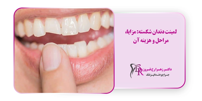 لمینت دندان شکسته: مزایا، مراحل و هزینه آن