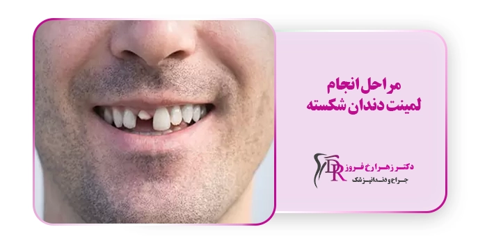 مراحل انجام لمینت دندان شکسته